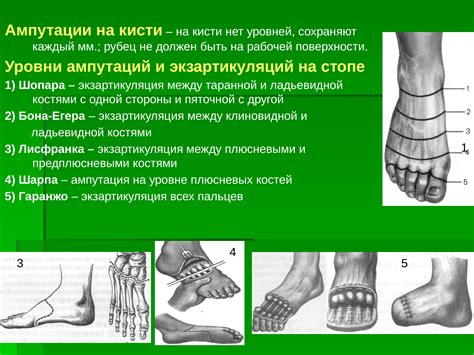 ампути|Ампутация конечностей: Виды, Причины и Жизнь。